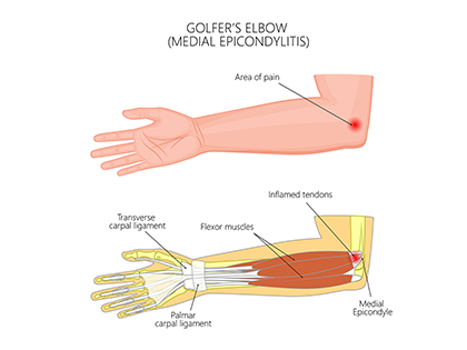 Golfer's elbow infographic